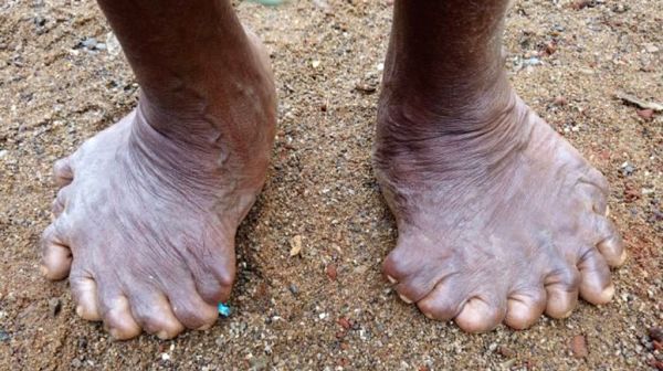 Woman born with 19 toes, 12 fingers sets new record
