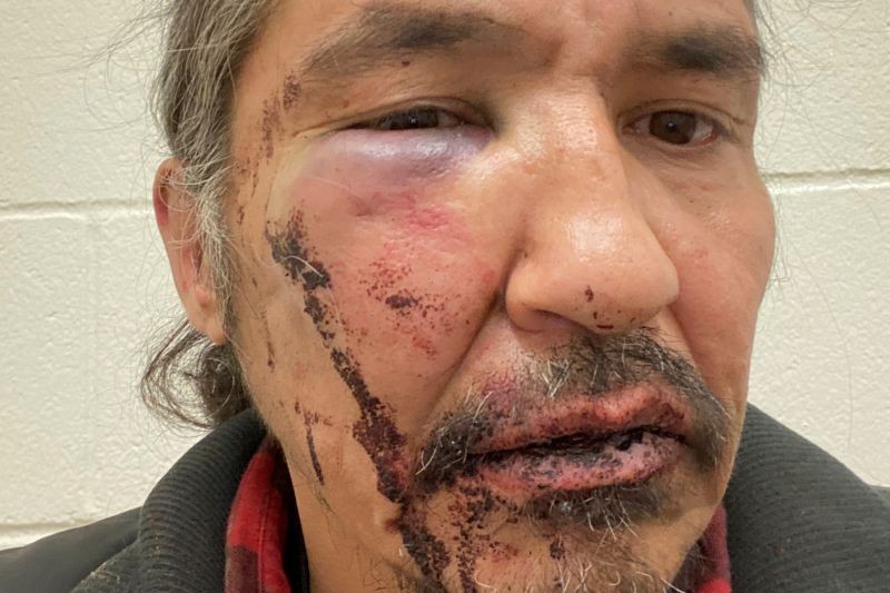 Chief Allan Adam of Athabasca Chipeywan First Nation displays his wounds that he says were caused by Royal Canadian Mounted Police (RCMP) officers of the Wood Buffalo detachment in an incident in Fort McMurray, Alberta, Ca