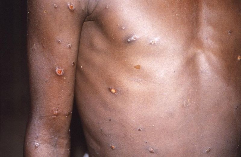 This 1997 image provided by U.S. Centers for Disease Control and Prevention shows the right arm and torso of a patient, whose skin displayed a number of lesions due to what had been an active case of monkeypox. As health authorities in Europe and elsewhere roll out vaccines and drugs to stamp out the biggest monkeypox outbreak beyond Africa, in 2022, some doctors are acknowledging an ugly reality: The resources to slow the disease's spread have long been available, just not to the Africans who have dealt with it for decades. ( AP File Photo)