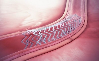 PGI Chandigarh performs first robotically assisted bioresorbable stent implantation. (IANS Photo)