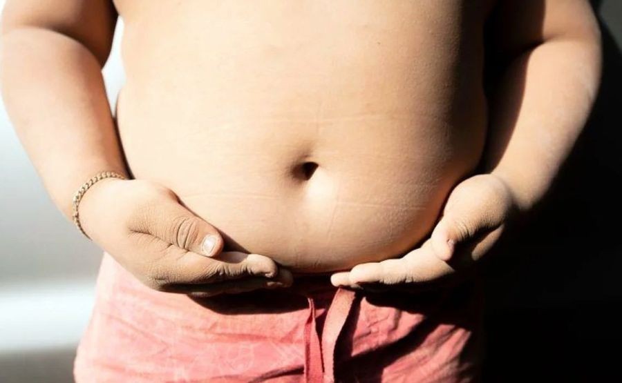 Childhood obesity
